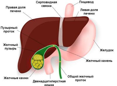 Камни в печени