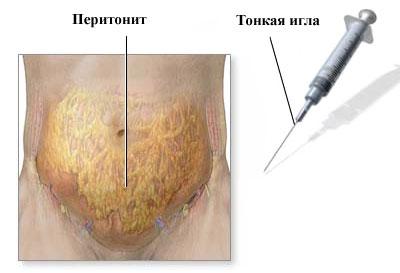 Выявление перитонита