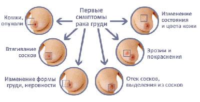 Признаки рака груди