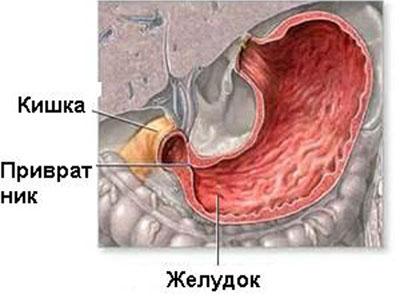 Стеноз желудка