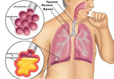 Проявление пневмонии