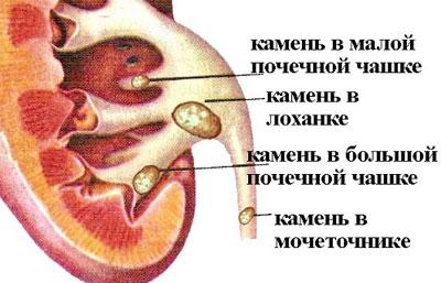 Камни в почках