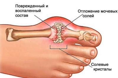 Проявление подагры