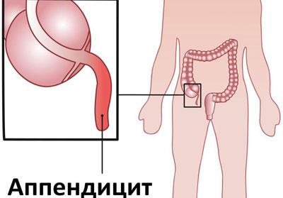 Воспаление аппендицита