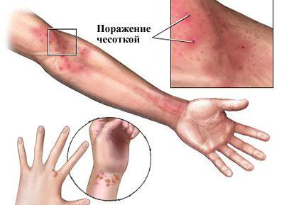 Проявление чесотки