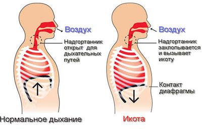 Возникновение икоты