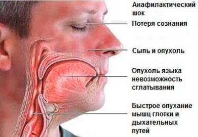 Признаки отека квинке