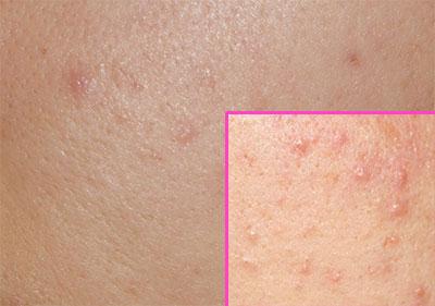 Угревая сыпь