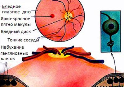 Эмболия сетчатки глаза