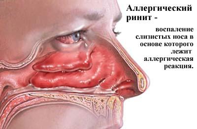 Воспаление при рините