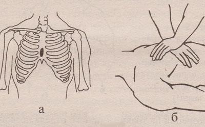 Массаж сердца