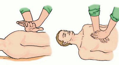 Непрямой массаж сердца