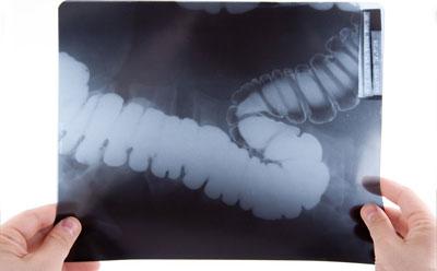 Дуоденография желудка