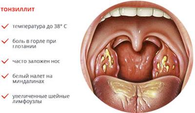 Симптомы тонзилита