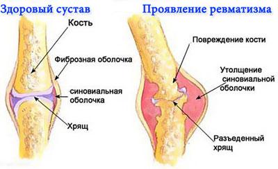 Проявление ревматизма