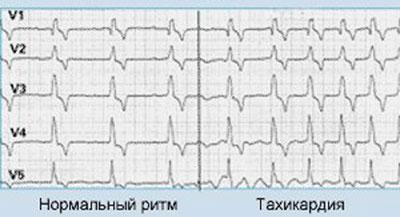 Проявление тахикардии