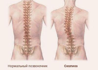 Проявление сколиоза