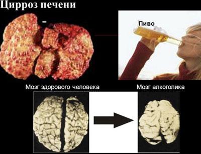 Печень и мозг алкоголика