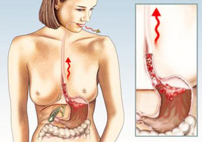 Желудочно-кишечное кровотечение
