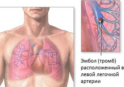 Проявление тромбоэмболии
