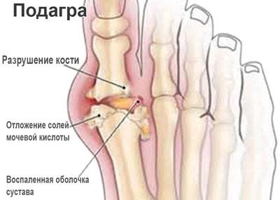Проявления подагры