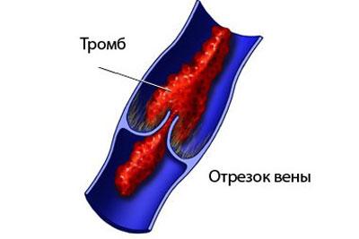 Образование тромба