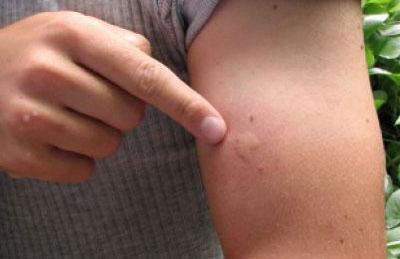 Укус насекомого