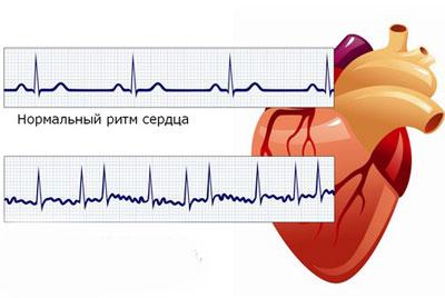 Нормальный сердечный ритм