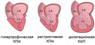 Виды кардиомиопатии