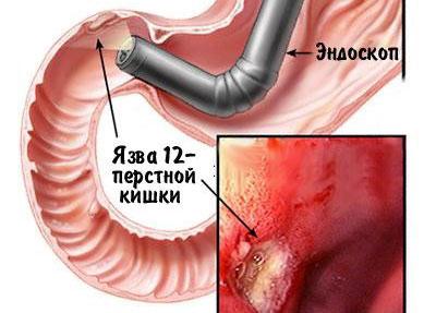 Язва двенадцатиперстной кишки