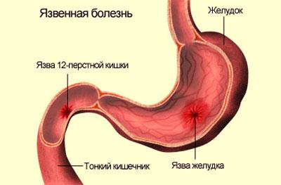 Язвенная болезнь