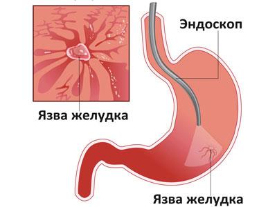 Язвенная болезнь желудка