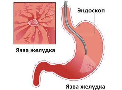 Язва желудка