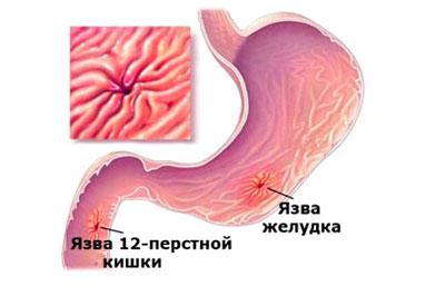 Язвенная болезнь