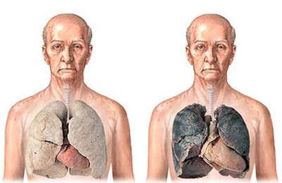 Легкие курильщика