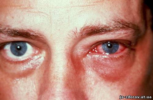 острая болезнь