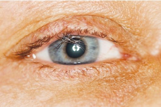 глаза при болезни