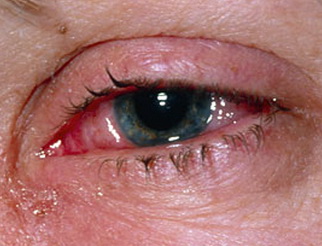 больной глаз