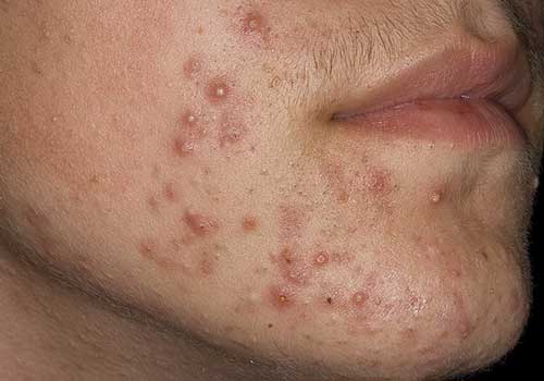 демодекоз лица