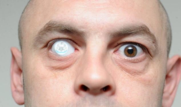 бельмо как выглядит