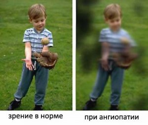 признаки ангиопатии