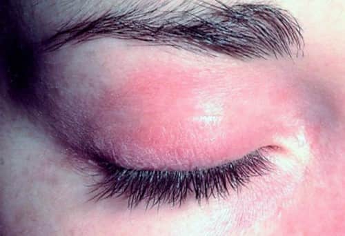 покраснение глаз