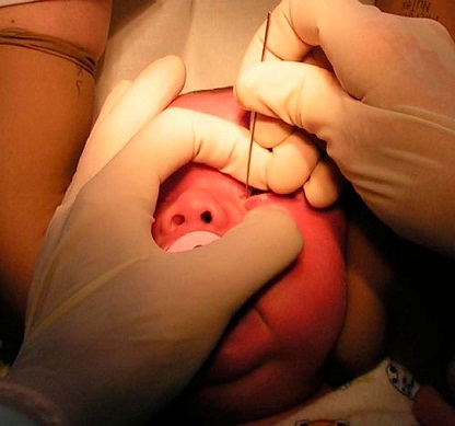 лечение дакриоцистита у детей