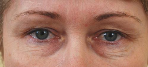 отечность глаза