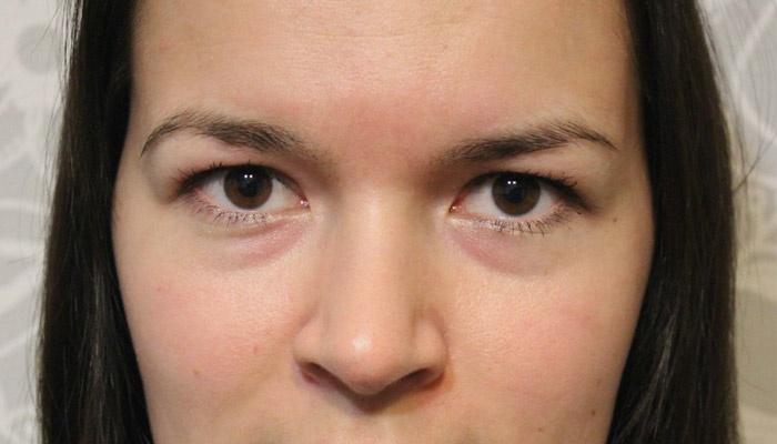 лечение отеков под глазами