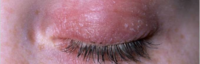 причины покраснений вокруг глаз