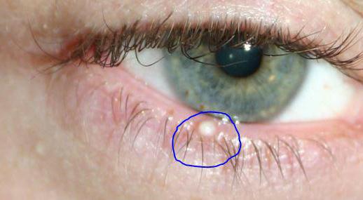 лечение кисты