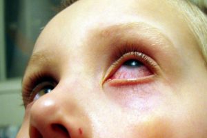 красные глаза