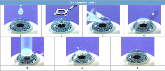 особенности ласика