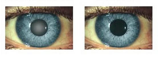 глаза астигматизм